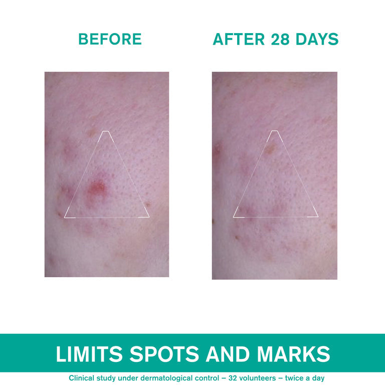 Hyséac 3-Regul+ Global Anti-Blemish Care