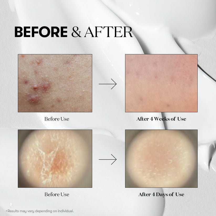 Microneedling Serume Reedle Shot 100