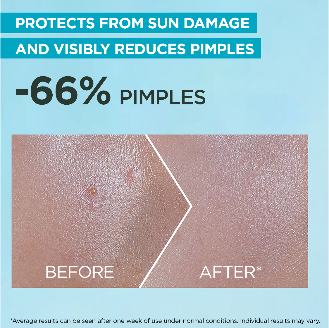 SuperUV Anti-Acne SPF50+ Sunscreen